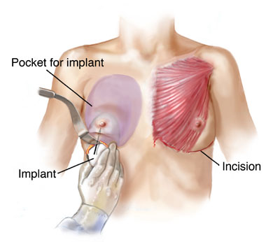 Implant insertion procedure