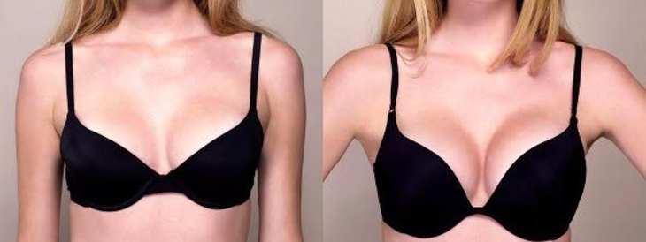 natural breast enhancement before after